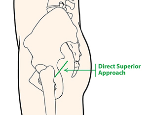 Minimally Invasive Total Hip Replacement