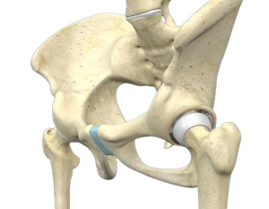 Anterior Hip Replacement